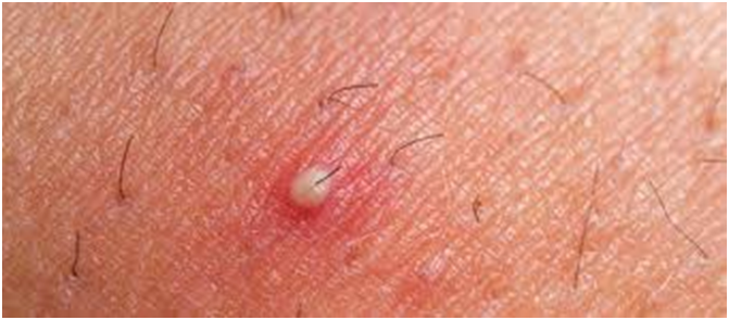 infecciones bacterianas de la piel