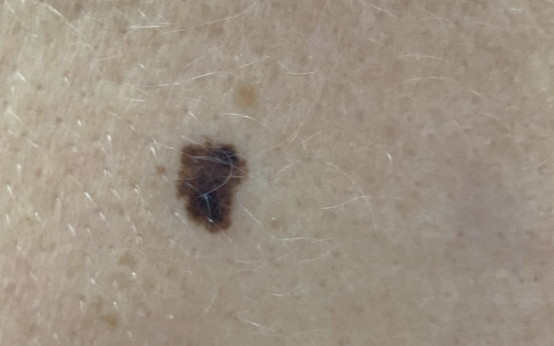 melanoma